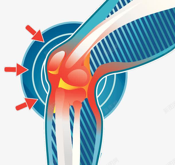 膝关节发炎插图png免抠素材_88icon https://88icon.com 关节炎 插图 疼痛 连接处 骨头