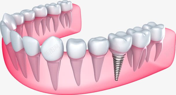 卡通种植牙模型png免抠素材_88icon https://88icon.com 卡通 模型 种植牙 种植牙原理