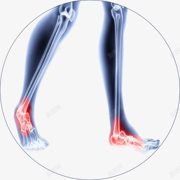 手绘足足跟痛图示png免抠素材_88icon https://88icon.com 拍片 生病病痛 疼痛 足跟痛 足跟痛贴设计 骨伤科 骨折 骨科 骨骼透视图