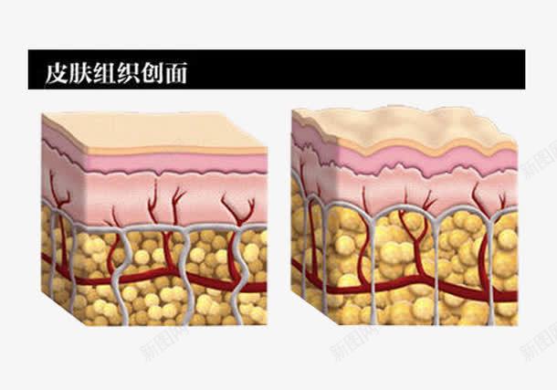 皮肤组织创面png免抠素材_88icon https://88icon.com 皮下组织 肌肤组织 解剖图