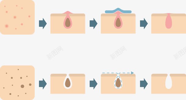 毛孔皮肤png免抠素材_88icon https://88icon.com 剪刀 卡通痘痘 毛孔 痘痘 皮肤 矢量PNG 面部 颜色