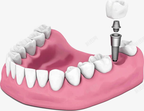 医院种植牙模型png免抠素材_88icon https://88icon.com 医院 填补 牙科 种植牙模型