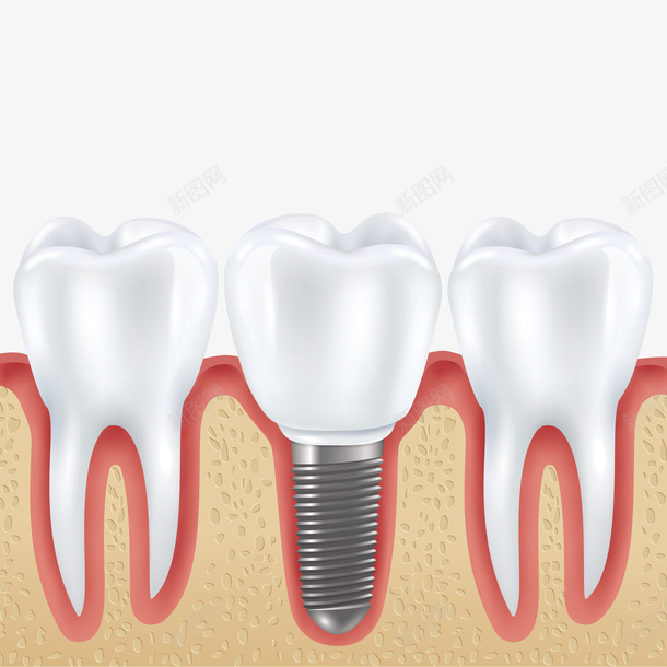 种植的牙齿和正常的牙齿png免抠素材_88icon https://88icon.com 两种牙齿 牙齿 牙齿png 牙齿矢量图 种植牙 种牙