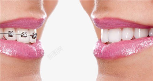 牙齿矫正png免抠素材_88icon https://88icon.com 女人 爱美 牙齿 矫正 美丽