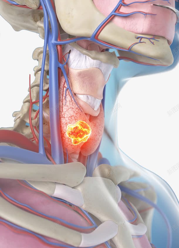 甲状腺结节疾病png免抠素材_88icon https://88icon.com 炎症 甲状腺 疾病 经脉 血液