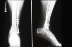 肢体骨骼被钉钉子修复中的脚踝骨透视片高清图片