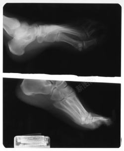 肢体骨骼左脚骨骼X光透视片高清图片