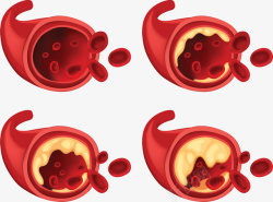 生物科学血管栓塞矢量图素材