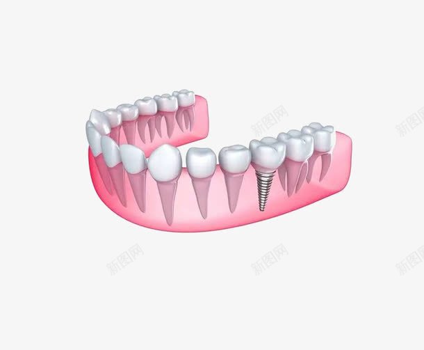 种植牙示意图png免抠素材_88icon https://88icon.com 医院用 宣传用 示意图 种植牙