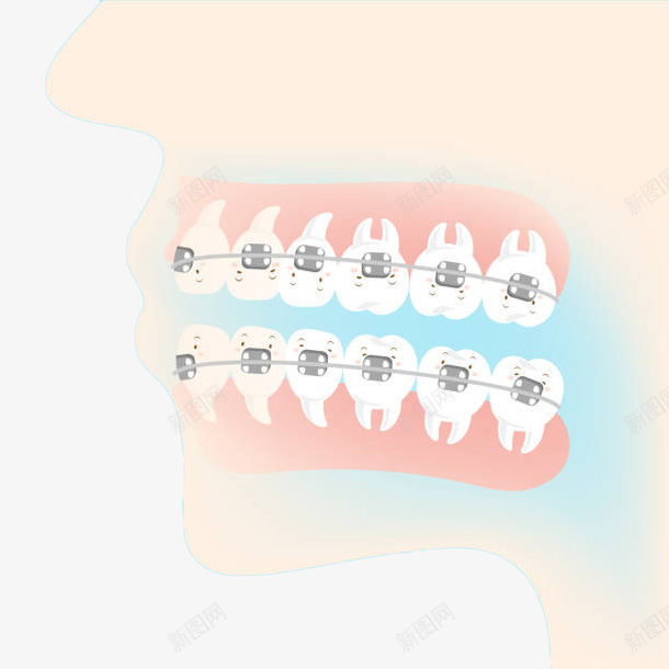 卡通矫正牙齿图示插画png免抠素材_88icon https://88icon.com 卡通 图示 头像 插画 牙套 牙科 牙齿 牙齿修护卡通图 矫正牙齿