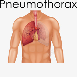 医疗内科疾病气胸矢量图素材