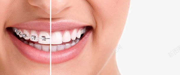 带牙套的美女png免抠素材_88icon https://88icon.com 健康牙齿 带牙套的美女 牙套 牙科 牙齿 牙齿美白 矫正洁白