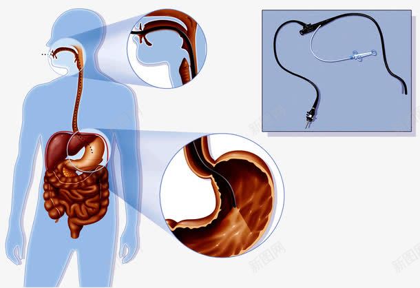胃镜手术插图png免抠素材_88icon https://88icon.com 医疗 手术 胃肠 胃镜