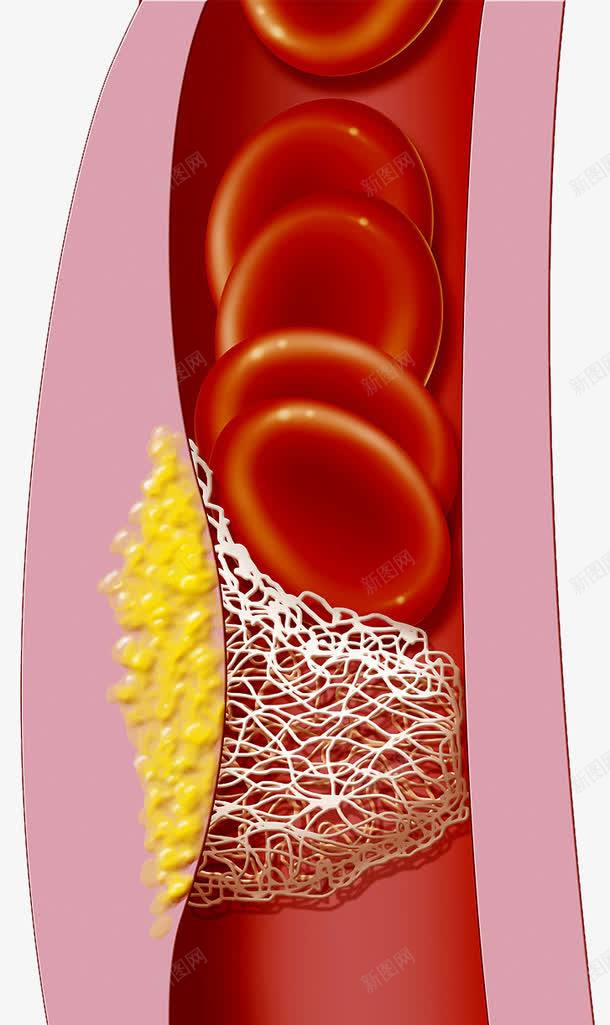 血管脂肪png免抠素材_88icon https://88icon.com 胆固醇 脂肪 血小板 血管