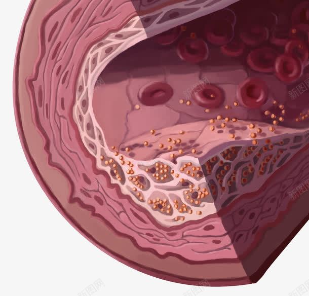 血管动脉硬化png免抠素材_88icon https://88icon.com 胆固醇 血小板 血管硬化 血脂细胞