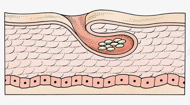 皮肤结构插图png免抠素材_88icon https://88icon.com 炎症 皮层组织 皮肤结构 细胞 面部皮肤结构
