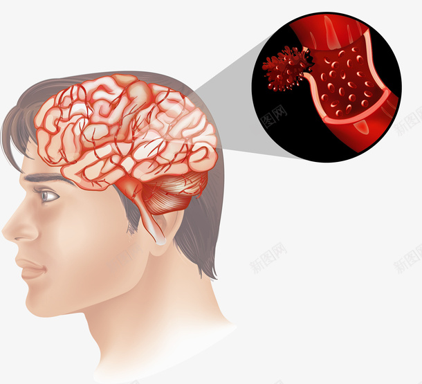 人类大脑血管分析图矢量图ai免抠素材_88icon https://88icon.com 人类大脑 人脑图 分析图ps 医学 医学分析图 大脑 大脑血管 矢量png 矢量图 脑浆 透视的大脑