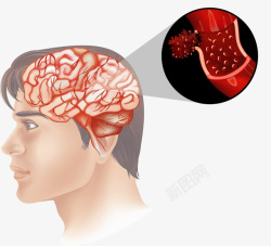 脑血管免抠图人类大脑血管分析图矢量图高清图片