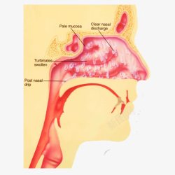 鼻炎形成示意图素材