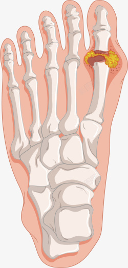 人体疾病人体足部骨质增生矢量图高清图片