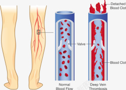 血管堵塞矢量图素材