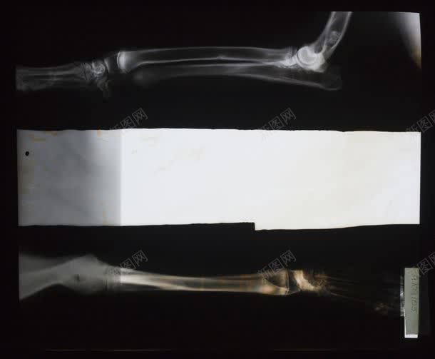 两个骨骼X光对比效果jpg设计背景_88icon https://88icon.com X透视 两个骨骼X光对比效果图片 两个骨骼X光对比效果图片素材下载 其它类别 医疗 图片素材 拍X光线 肢体骨骼 背景花边 骨科 骨骼对照