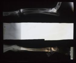 肢体骨骼两个骨骼X光对比效果高清图片