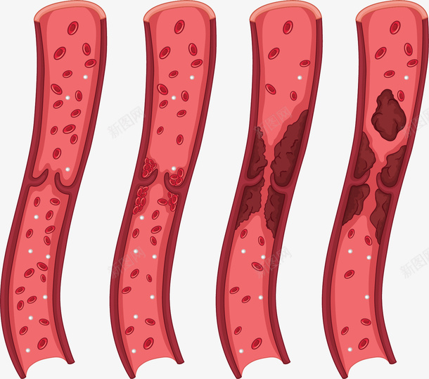 人类血管栓塞变化矢量图ai免抠素材_88icon https://88icon.com 人类病变 人类血管 病变 矢量png 血管 血管病变 矢量图