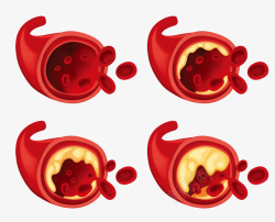 人体红色血管堵塞矢量图素材