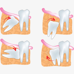 牙痛卡通四种智齿生长方向图示插画免高清图片