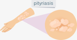 皮肤病手臂皮肤病蛇皮癣矢量图高清图片