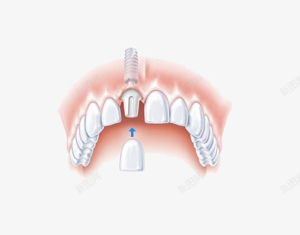 种植牙示意图png免抠素材_88icon https://88icon.com 医药医学 医院用 示意图 种植牙