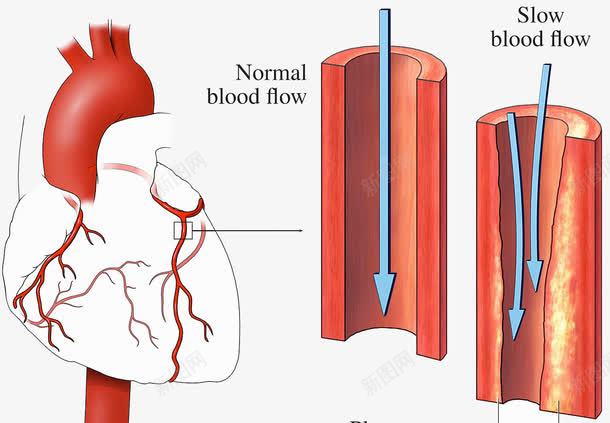动脉硬化png免抠素材_88icon https://88icon.com 不健康饮食方式 动脉硬化 心脑血管 胆固醇