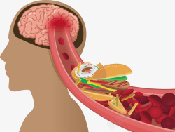 大脑血管堵塞矢量图素材