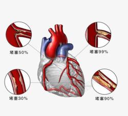 心脏疾病素材