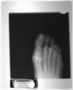 肢体骨骼右脚X光透视高清图片
