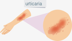 皮肤病荨麻疹放大图素材