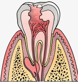 牙根龋齿牙根插图高清图片