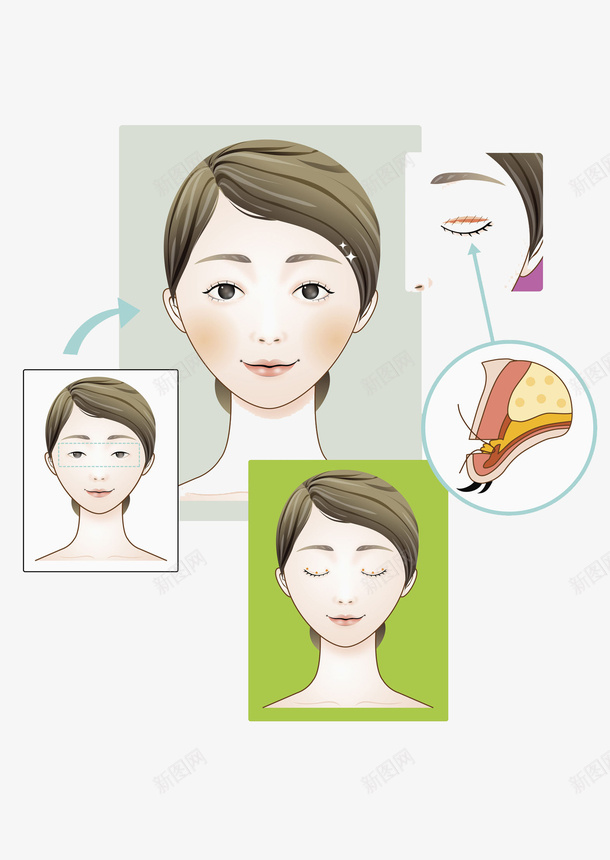 整容整形手绘平面示意图png免抠素材_88icon https://88icon.com 割双眼皮 卡通 女士 女性 平面 微整 微调 整容整形 漂亮女士 韩式半永久