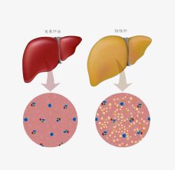 正常肝脏和脂肪肝对比图素材