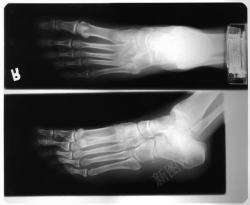 肢体结构足部X光摄影高清图片