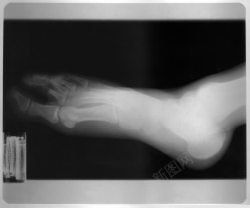 肢体结构脚x光片摄影高清图片