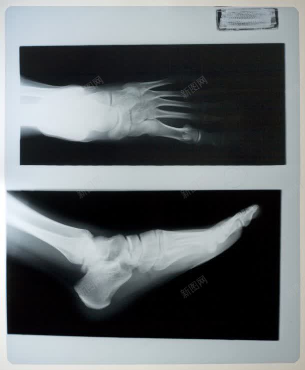 手和脚x光图像jpg设计背景_88icon https://88icon.com x光 人体 其它类别 医疗 图像 图片素材 手 手和脚x光图像图片 手和脚x光图像图片素材下载 拍X光线 检查 背景花边 脚 透视