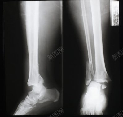 骨折的小腿x光图像背景