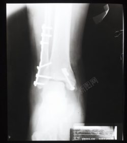 骨折的脚踝图片骨折的脚踝高清图片