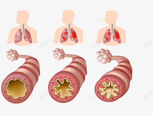 支气管哮喘png免抠素材_88icon https://88icon.com 医疗 哮喘 气道炎症 气道阻力