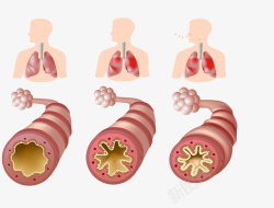 支气管支气管哮喘高清图片