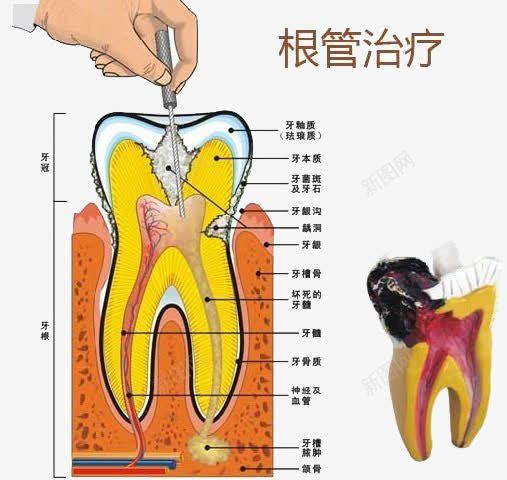 根管治疗png免抠素材_88icon https://88icon.com 根管 治疗 牙齿 蛀牙