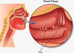 人体鼻窦炎医学研究分析素材