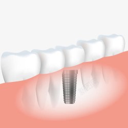 牙齿健康修复图素材
